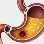 Cikakken Bayani akan Ulcer: Maganin Ulcer da Hanyoyin da Za a Rage Saurin Tashin Ciwon